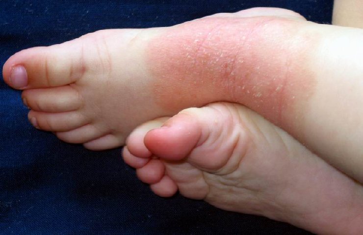 Bambino affetto da dermatite atopica