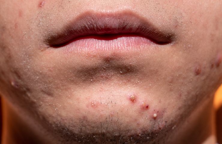 Acne sul viso di un uomo