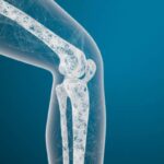 Campagna informativa sull'osteoporosi in Italia