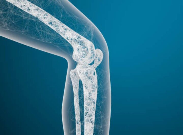 Campagna informativa sull'osteoporosi in Italia