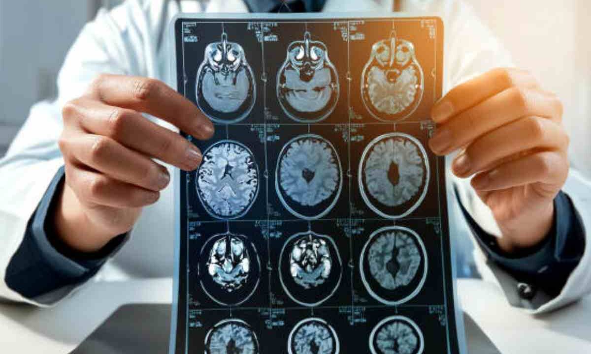 Diagnosi sclerosi multipla con l'IA
