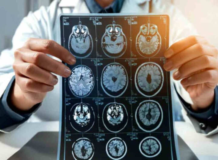 Diagnosi sclerosi multipla con l'IA