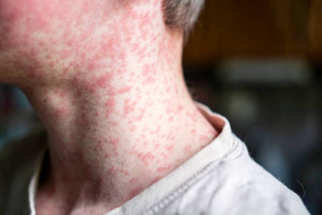 Il morbillo in Italia e nel mondo