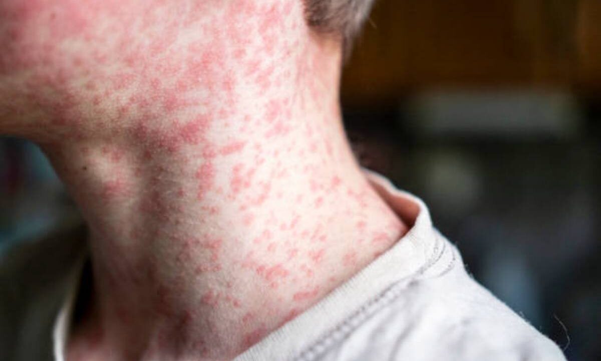 Il morbillo in Italia e nel mondo