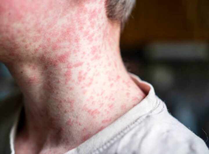 Il morbillo in Italia e nel mondo