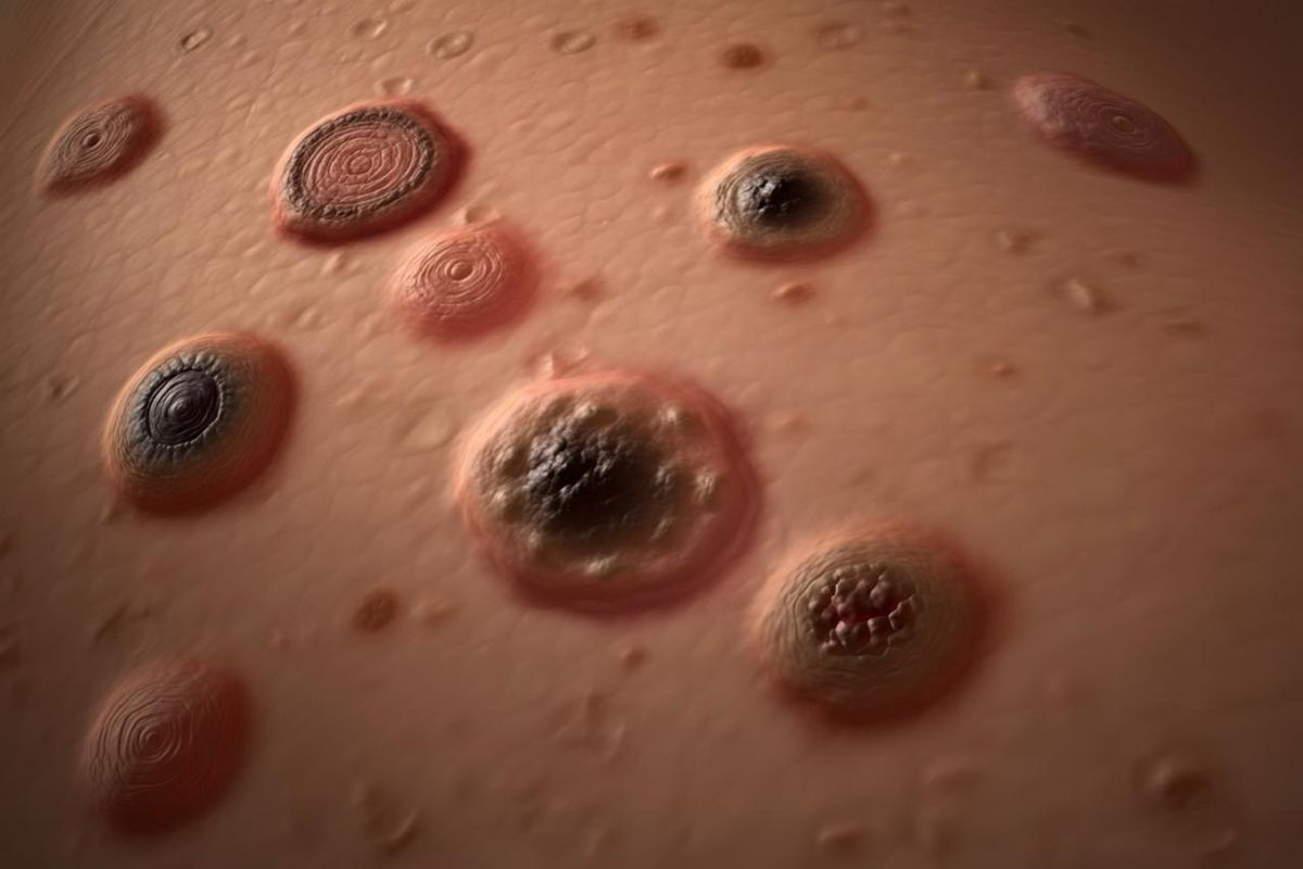 Controllo nei: ecco quando è fondamentale farlo