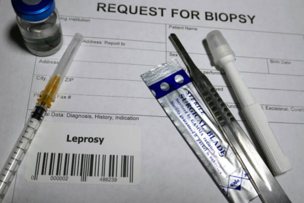 La lebbra è ancora pericolosa?