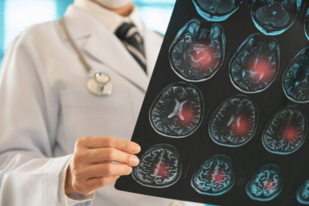 Ictus: nuovo farmaco per diminuire il rischio di recidiva