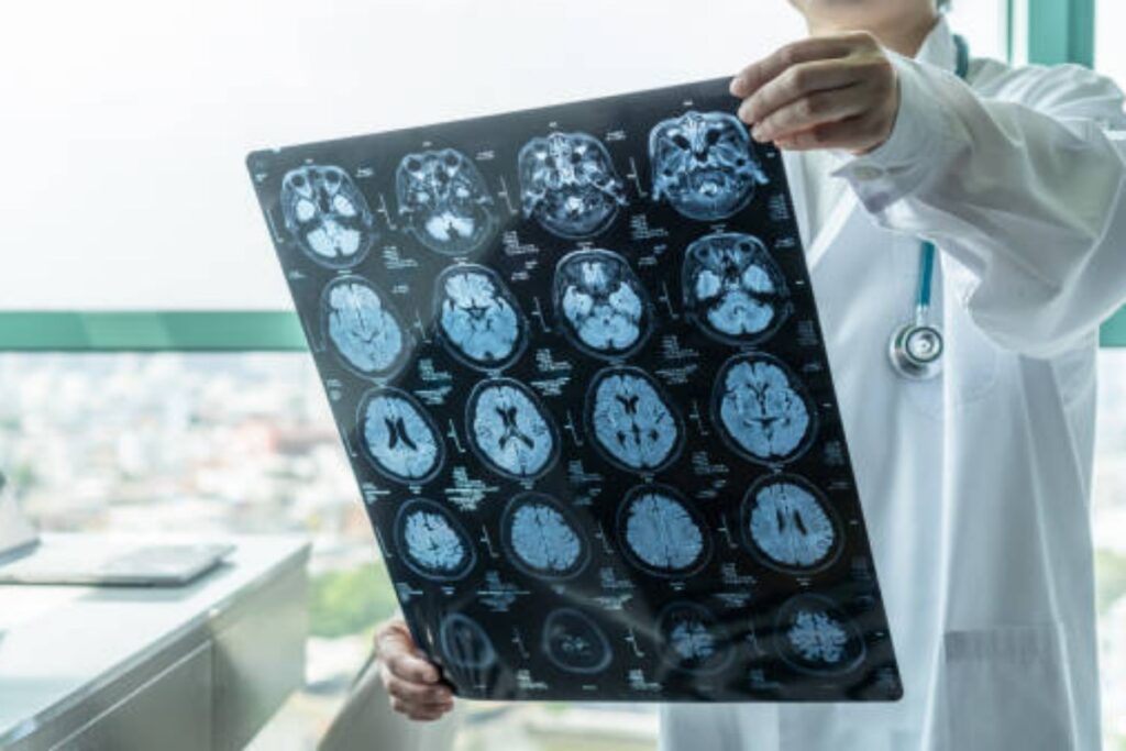 Meningite tubercolare