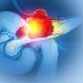 Tumore al pancreas