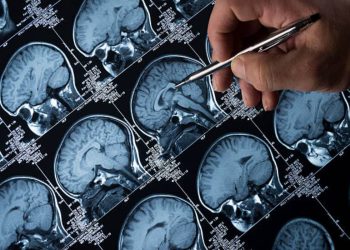 Tumori del cervello pediatrici