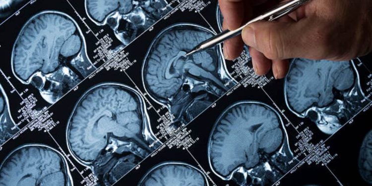 Tumori del cervello pediatrici